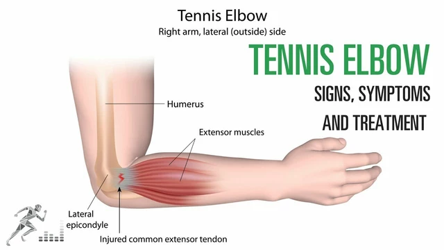 What is tennis elbow treatment?